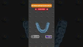 Anterior Repositioning Splint designed in #blenderfordental software