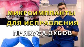 Исправление прикуса микро имплантами и брекетами. Ортодонты Люми-Дент в Киеве