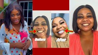 Ɛnyɛ Fɛ, Nipa Baako Surg£ries Bebree, See How Ghanaians Are Laughing At Empress Gifty Over New Teeth