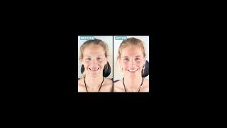 A New Confidence With Dental Implants GPS