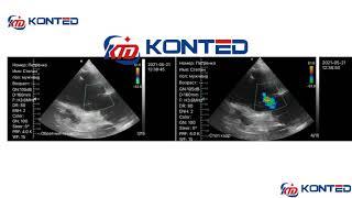 Wifi&USB cardiac probe color mode from Beijing Konted