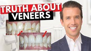 Before you get Dental Veneers Watch This! | Are Veneers Worth It?