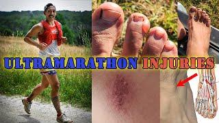 My Injuries From a 100 Mile Ultramarathon - Vermont 100