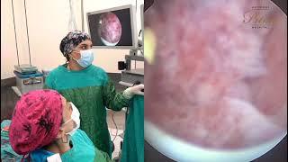 Endometrial polip. Dr. Şölə Əkbərova tərəfindən "Histeroskopik polipektomiya"