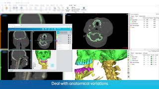 AI-Enabled Automatic CMF Segmentation | Mimics Innovation Suite 24