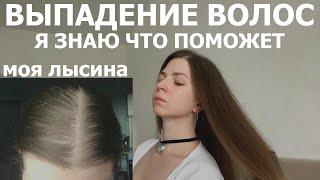 ВЫПАДЕНИЕ ВОЛОС | Я ЗНАЮ ЧТО ПОМОЖЕТ | У МЕНЯ АНДРОГЕННАЯ АЛОПЕЦИЯ 10 ЛЕТ #алопеция #алерана