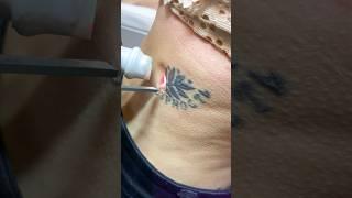 Удаляем тату - СЕРНОСТЬ  removing the tattoo #tattoo #tattooremoval #top #удалениетату