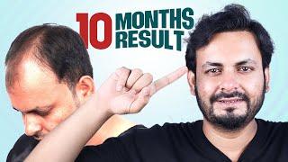 10-Month Results: 4800 Grafts  | Hair Transplant in Bangladesh | New Roots