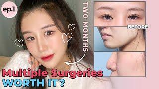 [SUB] Getting Multiple Procedures for a Proportionate and Smooth Facial Line in KOREA! | Contouring