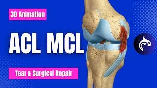 Разрыв и восстановление ACL MCL - 3D-анимация