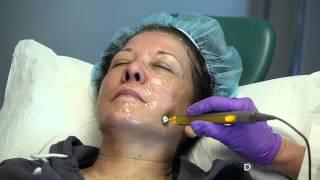 How does Pelleve radiofrequency skin tightening work? - Dr. Joel Erickson