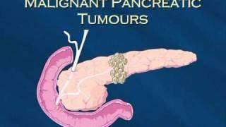 Pancreatic Cancer Patients Guide: 2 - Pancreatic Diseases