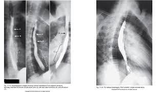 Radiographic Positioning of the Esophagus