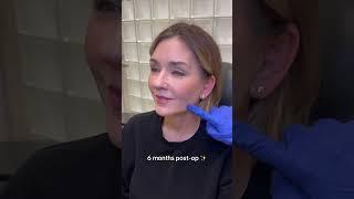Facelift expert #bestfacelift #faceliftbeforeandafter #faceliftspecialist #faceliftnatural #facelift