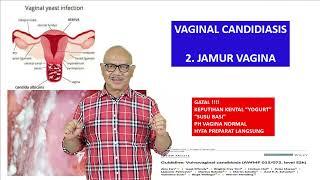 Keputihan karena Jamur Vagina | Volume 2 [SERI PENYEBAB KEPUTIHAN]