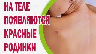 Почему на теле появляются красные родинки?