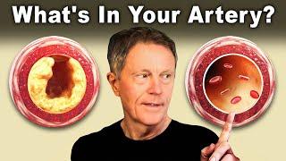 #1 Best AT HOME Test to Find Clogged Arteries