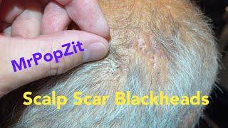 Scalp scar blackhead extractions. Scar tissue on scalp filling with keratin extracted. MrPopZit.