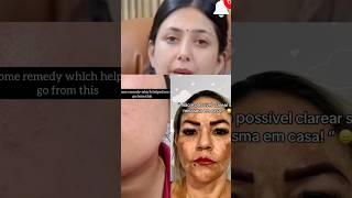 Dr. Upasana’s DIY High Pigmentation Removal | Homemade Remedy | 1 Month Challenge!#shorts#ytshots