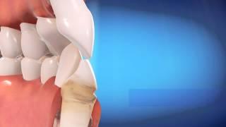 Straight Talk Video Ask a dental professional