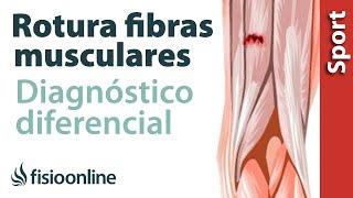 ¿Cómo diferenciar si tienes una rotura de fibras o una contractura o espasmo muscular?