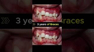 Fix supper crooked teeth with braces #orthodontist #braces #dentist