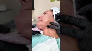 #facelift #pdothreadlift #skincare #pddeadlift #skinlifting #beauty #rfskincare