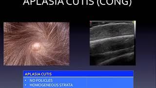 DERMATOLOGIC ULTRASOUND OF ALOPECIAS. DR F. ALFAGEME