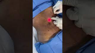 Endolift tx on the Abdomen to Melt Small Pockets of Stubborn Fat & Tighten the Skin - Ageless MD
