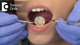 Can Root Canal Treatment be performed on mobile teeth? - Dr. Jayaprakash Ittigi