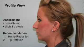 Tip Refinement, Tip Rotation & Hump Reduction | Dr. Buonassisi, 8 West Clinic in Vancouver BC