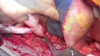 abdominal aortic replacement + bypass graft reattach + lt RA reattach + stent graft removal