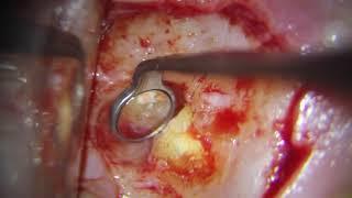 Endodontic microsurgery to upper molar