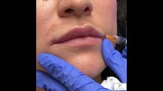 Lip Filler Cannula