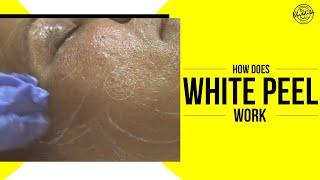 White Peel Really Works for skin brightening!  | Dadu Medical Centre
