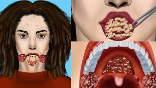 ASMR Treatment Of Oral Myiasis Animation - Maggots Removal From Mouth Wound ASMR | JINJJA 진짜 ASMR