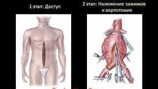 Аневризма брюшной аорты: определение, факторы риска, диагностика и лечение