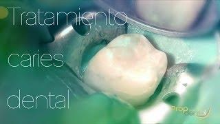 Tratamiento caries dental