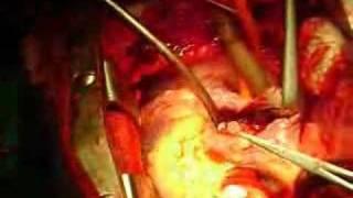 ASD patch closure on beating heart