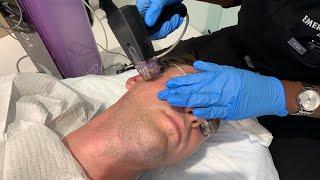 KEEP YOUR JAWLINE SNATCHED AND SKIN TIGHT WITH MORPHEUS 8 DEEP MICRONEEDLING RF | Dr. Jason Emer