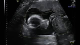 Baby Tobatto's Ultrasound