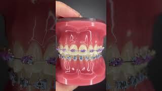 Different Types of Orthodontic Ties you can get at your Orthodontist Part 2