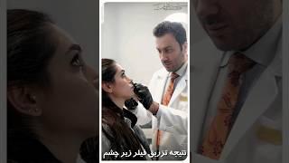 نتیجه فوق‌العاده تزریق فیلر زیر چشم