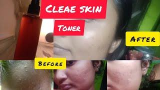 Toner get clear skin || Use this one remedy || glow &clear skin ||clear scar and acne 