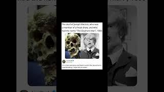 The skull of Joesph Merrick, who was a member of a freak show, and who had the name The Elephant Man