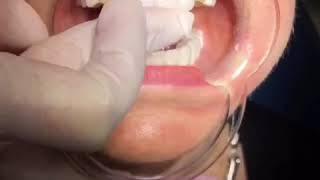 Porcelain Veneers Procedure Miami by Dr.Svetlana Anokhina