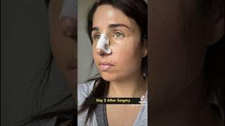 6 Week Rhinoplasty Amazing Results! + Recovery process #shorts