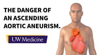 Surgeon describes an ascending aortic aneurysm | UW Medicine