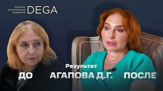 Елена Эдуардовна после комплексного омоложения. Интервью с пациентом Агапова Д.Г.