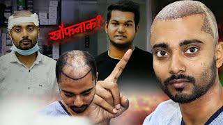 I Tried HAIR TRANSPLANT in India 2025 and Here's What Happened